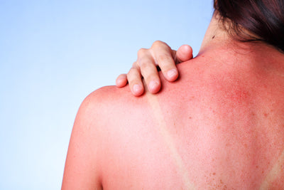 Smart Sun Protection : How to Prevent Sun Damage on Chest